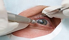 Best Cataract & Comprehensive Opthalmology In Pune