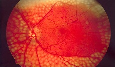 Best Diabetic Retinopathy & Hypertensive Retinopathy In Pune