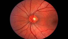 Best Glaucoma treatment In Pune